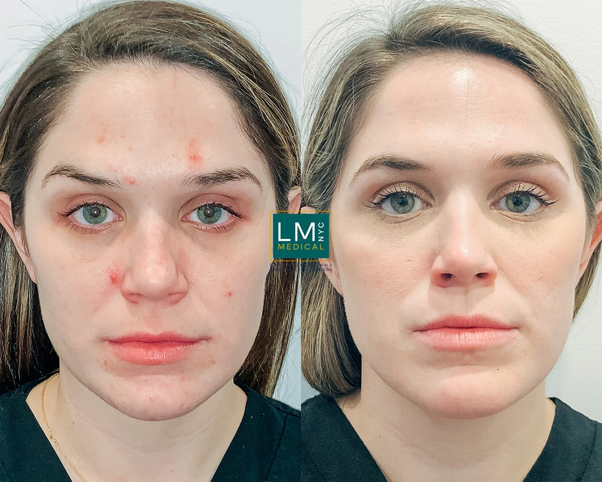 FaceAcne9.jpg