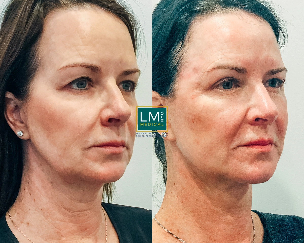 Facelift6.jpg