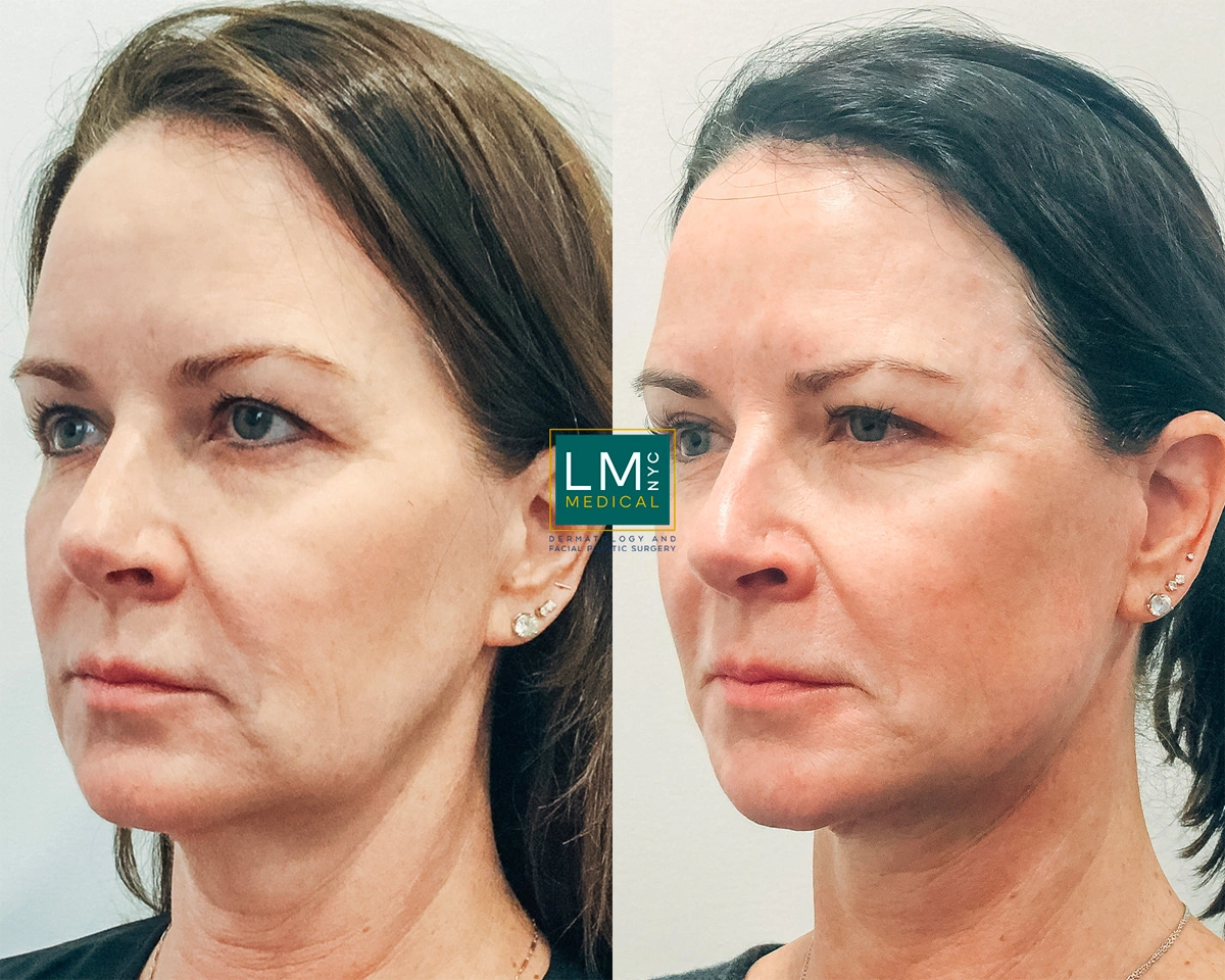 Facelift7.jpg