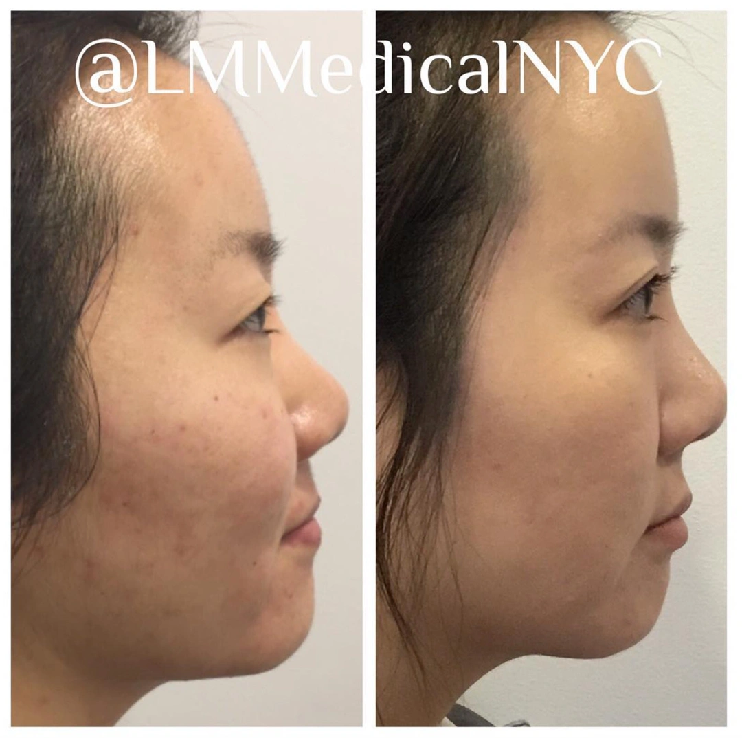Microneedling1.jpeg