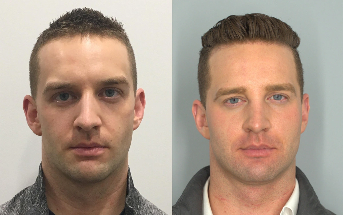 Rabach_Botox_Fillercheeks,jawline_FUE Hair transplant 1 year PRE1.png