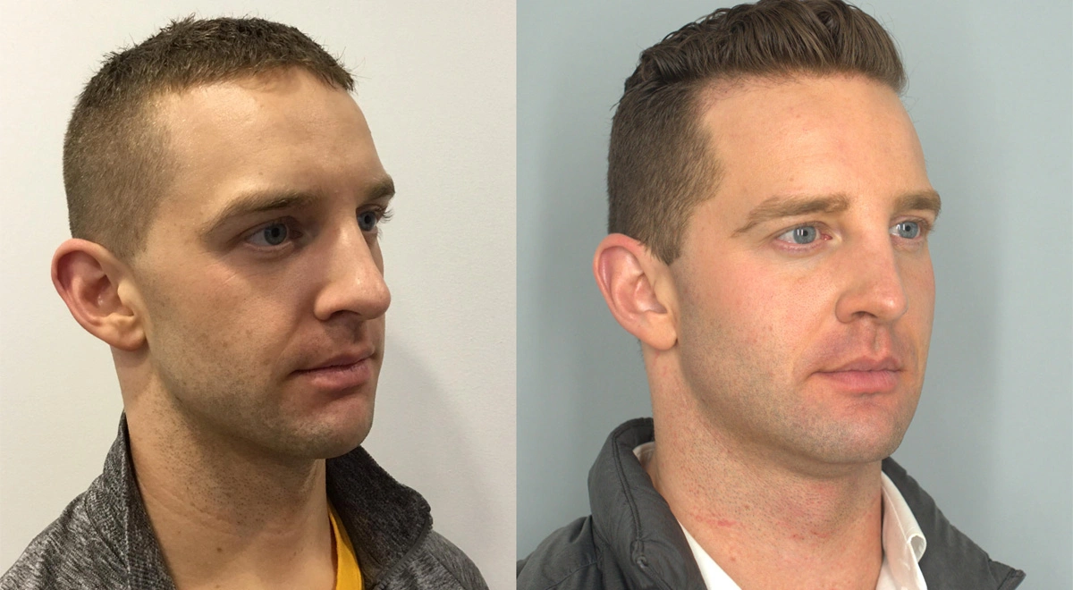 Rabach_Botox_Fillercheeks,jawline_FUE Hair transplant 1 year PRE2.png
