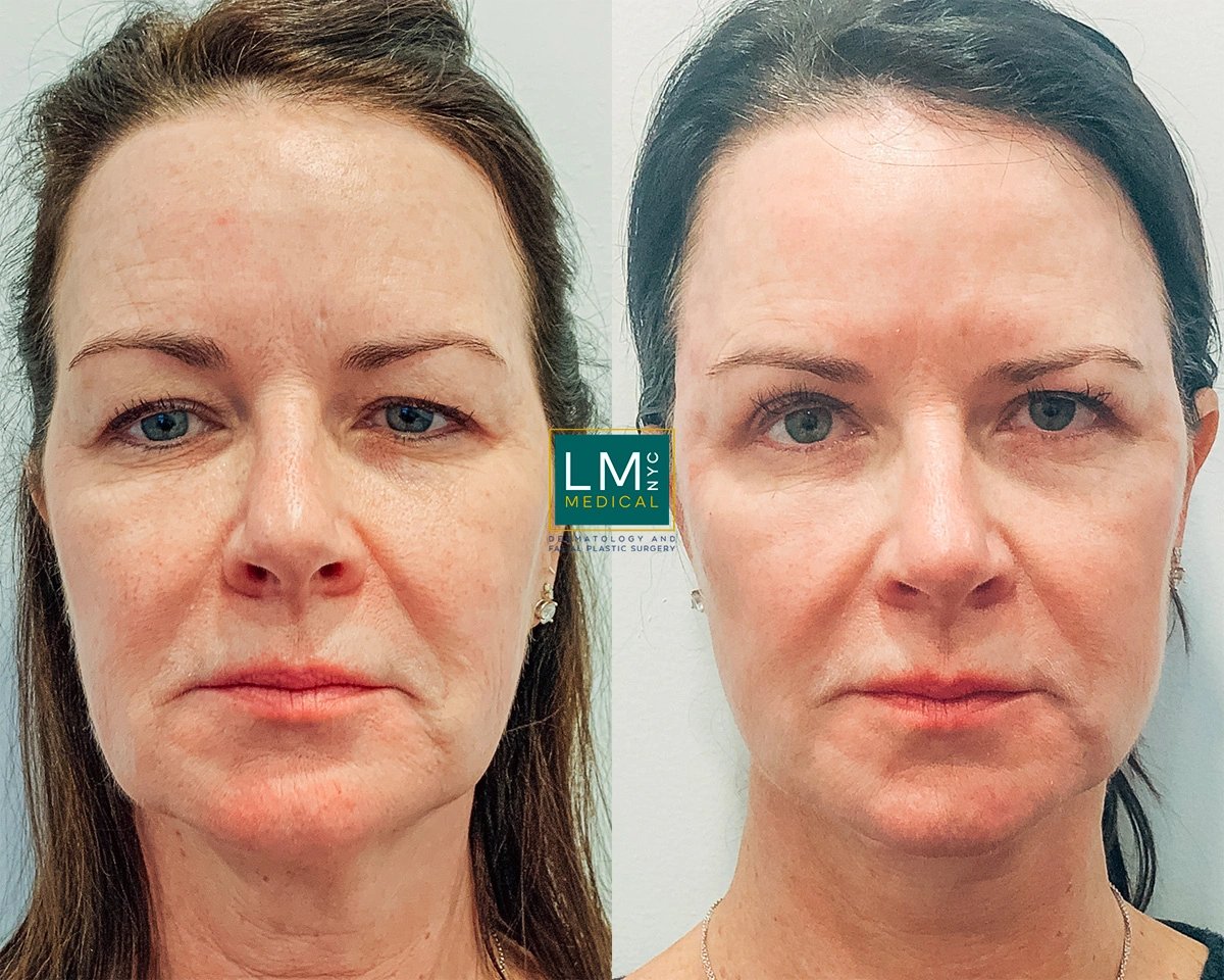 Ultherapy10.jpg