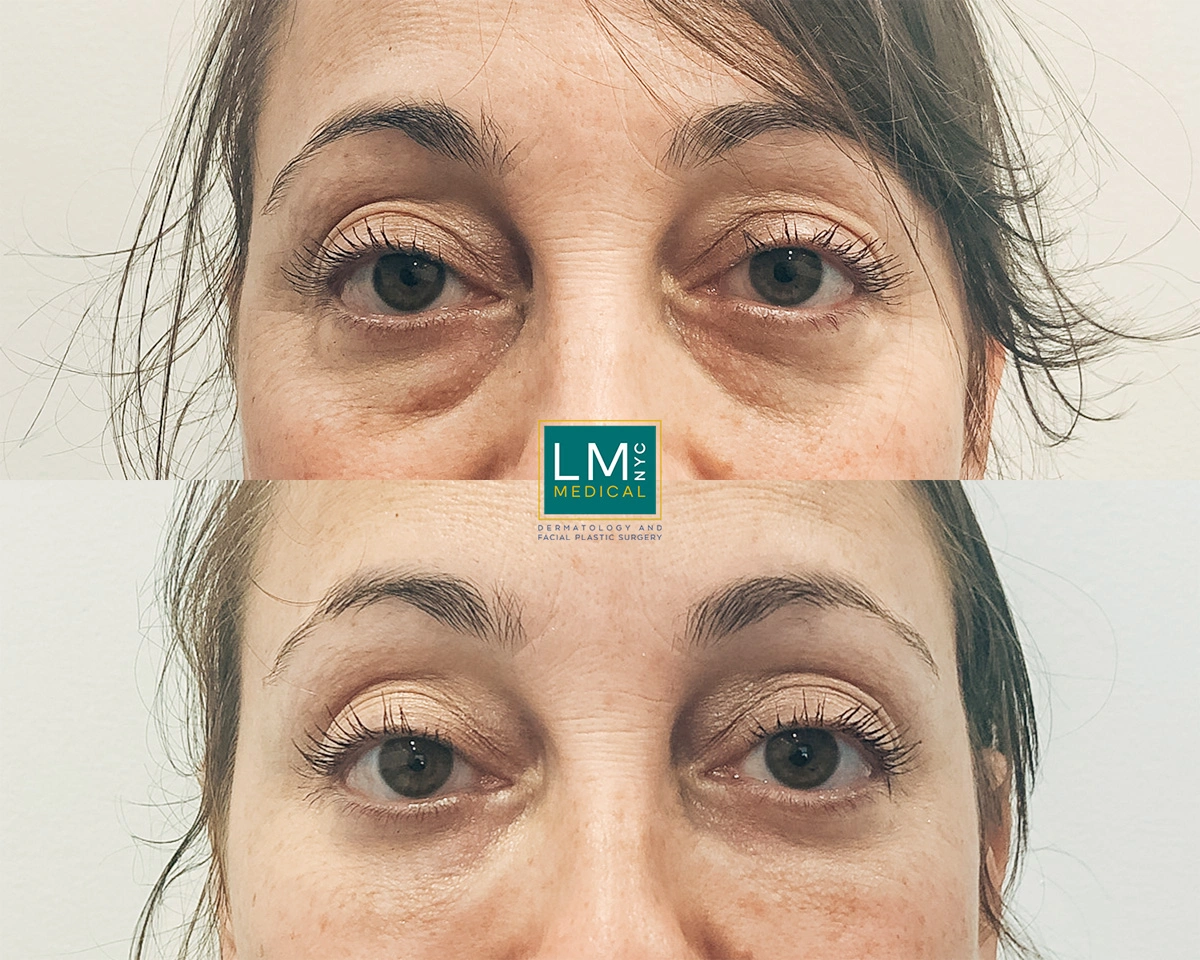 UnderEyeFiller15.jpg
