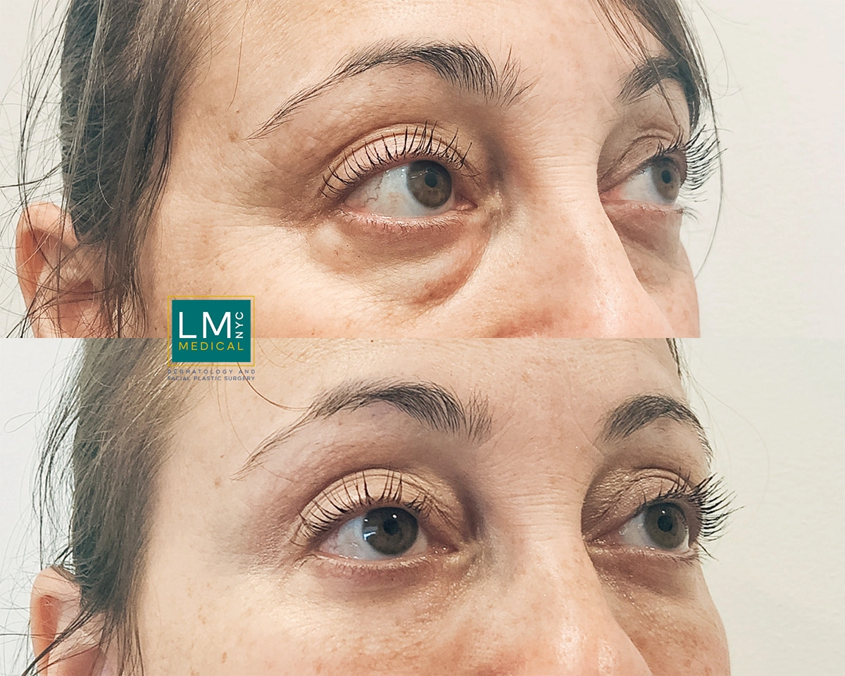 UnderEyeFiller16.jpg