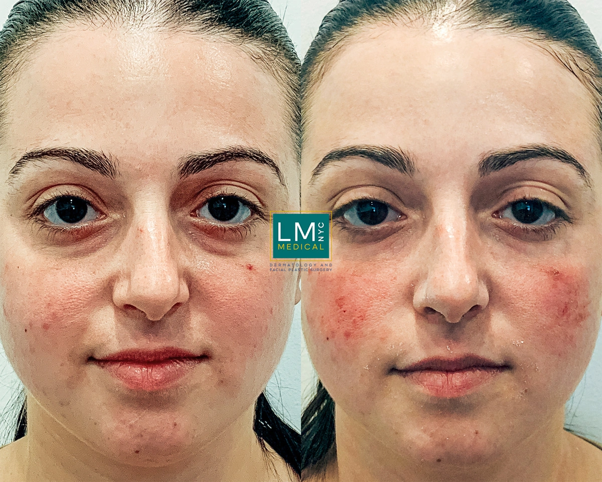 UnderEyeFiller20 2.jpg