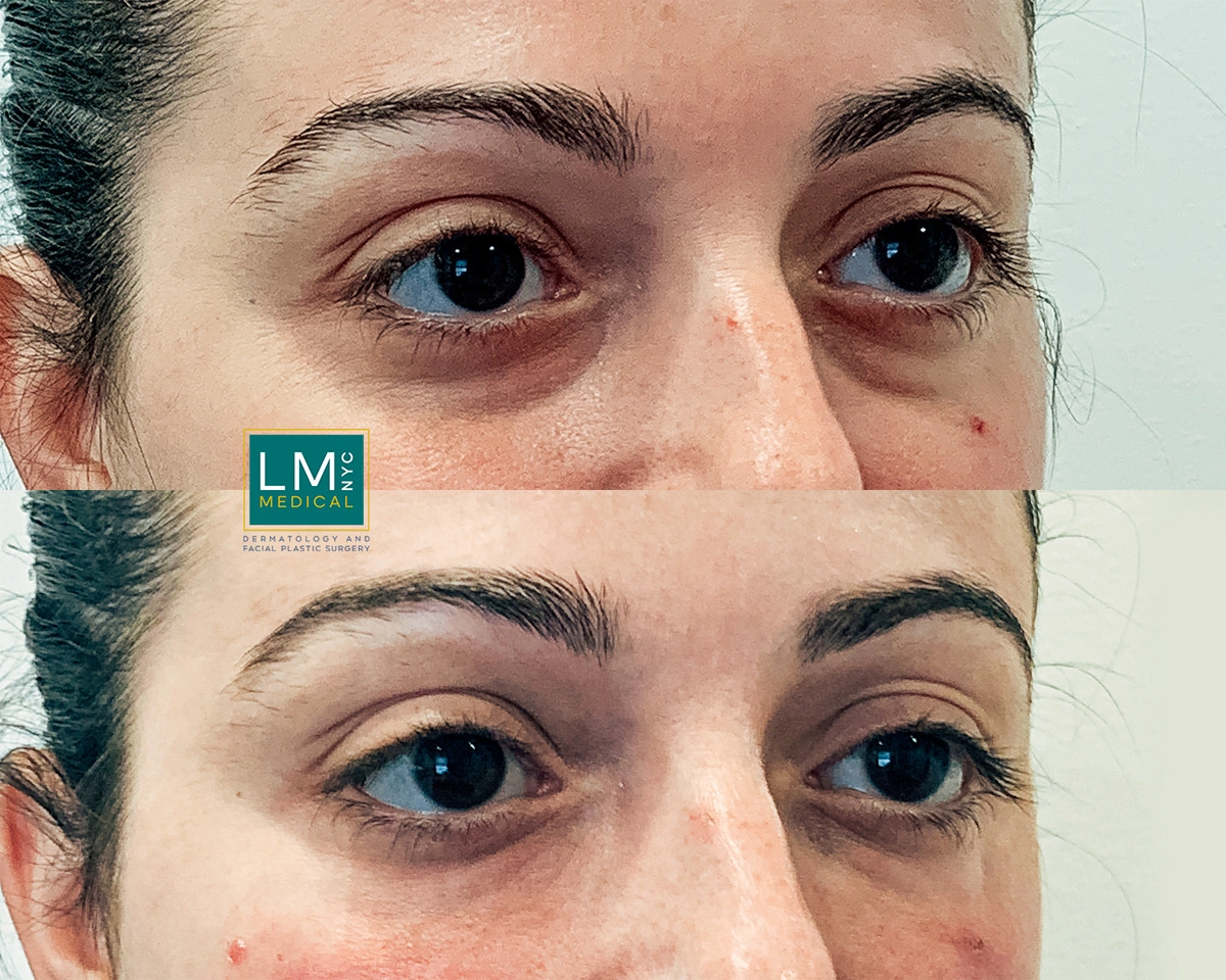 UnderEyeFiller21 2.jpg