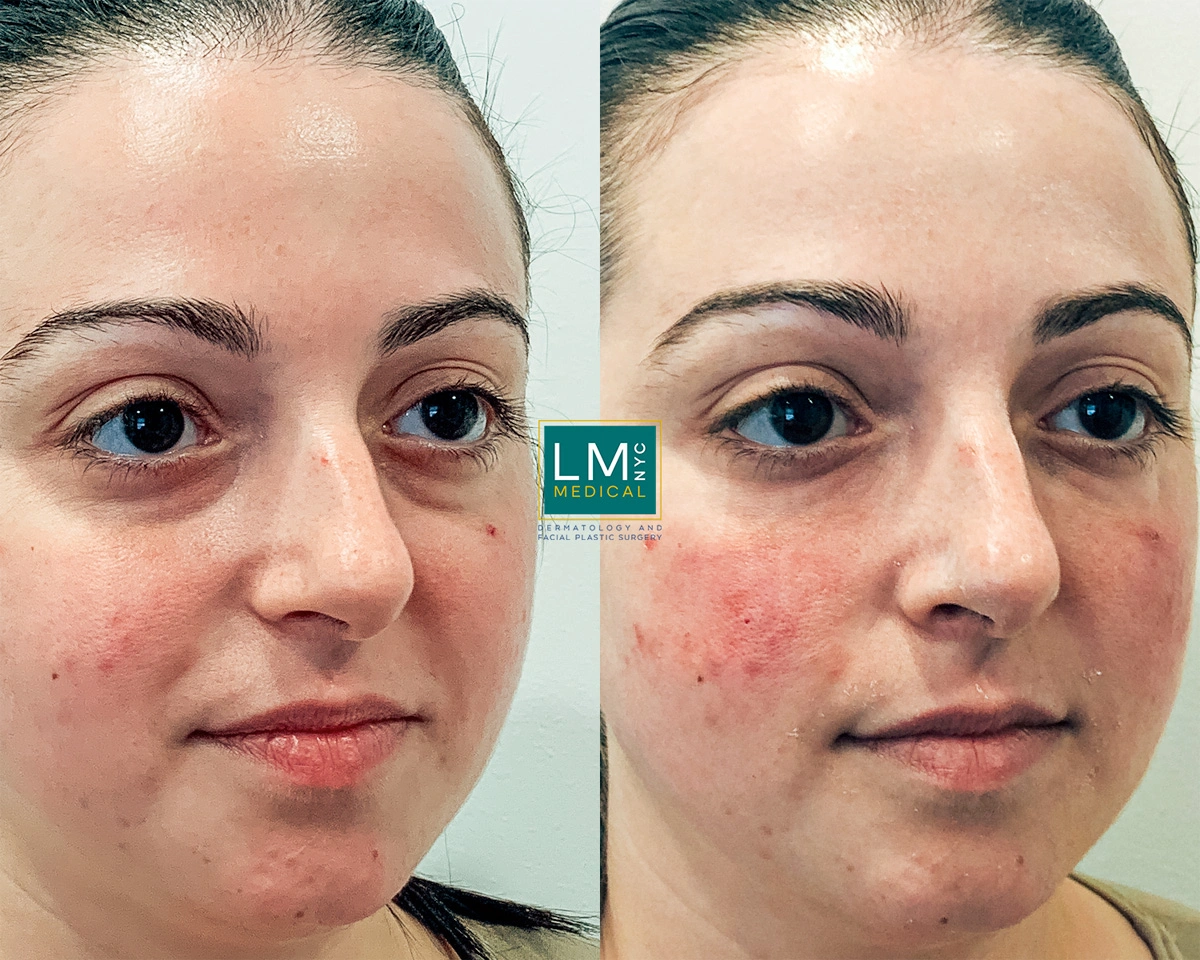 UnderEyeFiller22.jpg