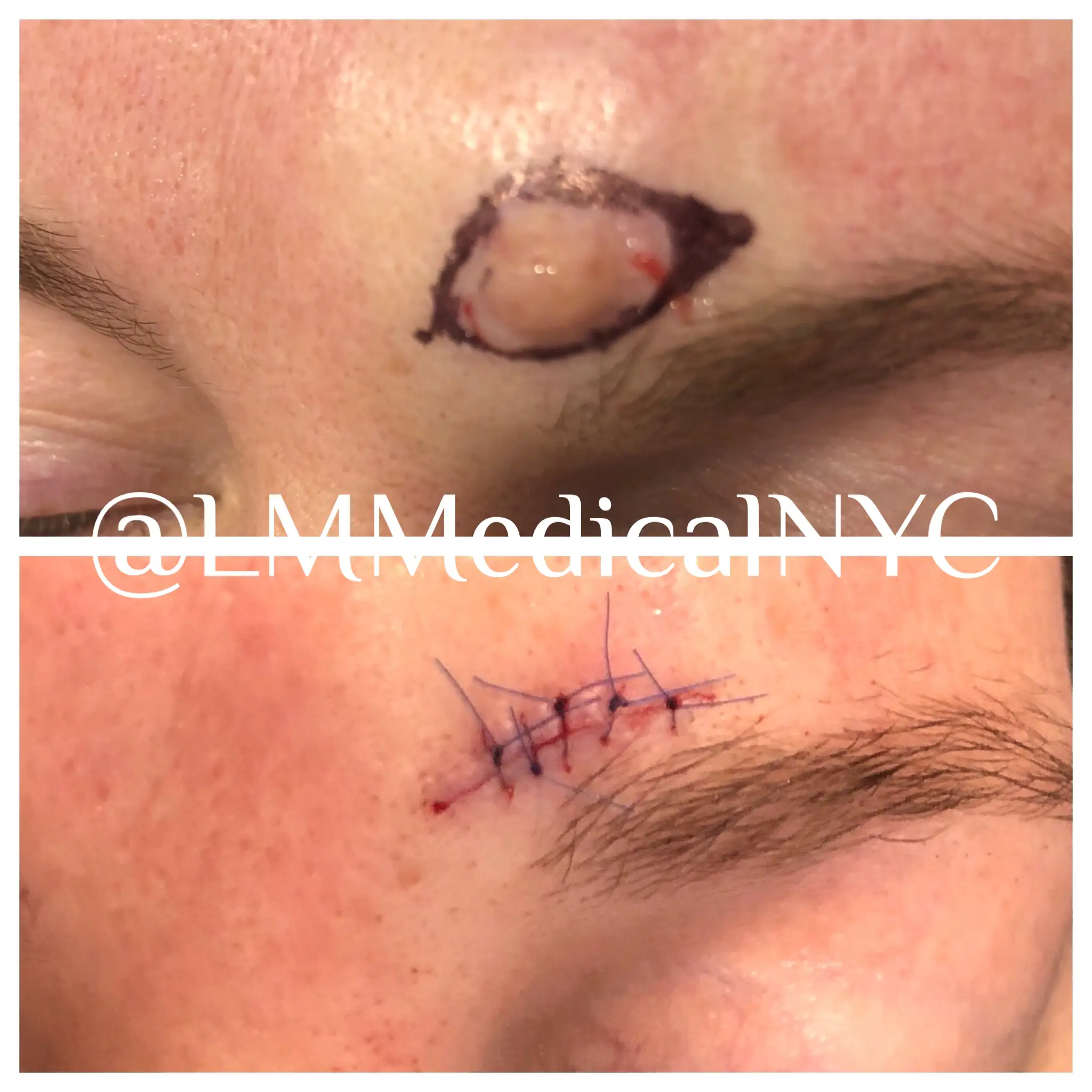 cosmeticexcision1-final