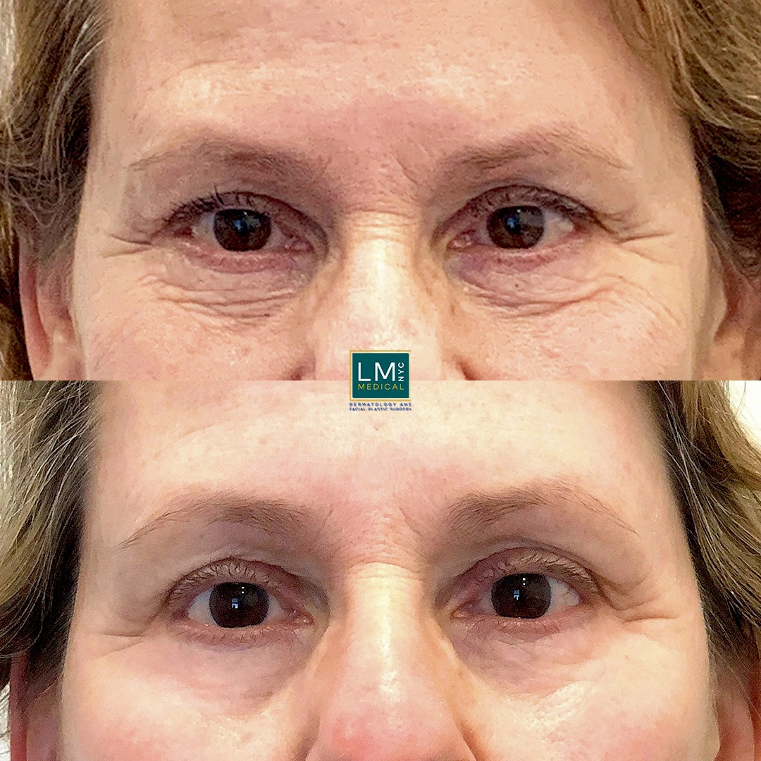 front Eyes Chemical Peel.JPG