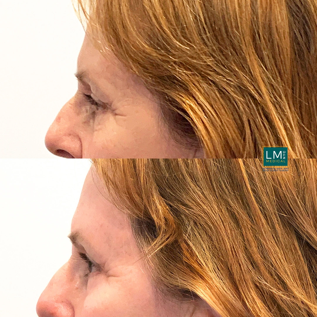 left Eyes Chemical Peel copy.JPG