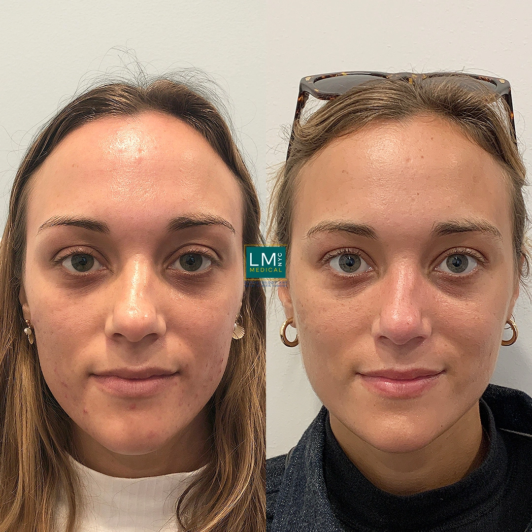 microneedling b&a front copy.JPG