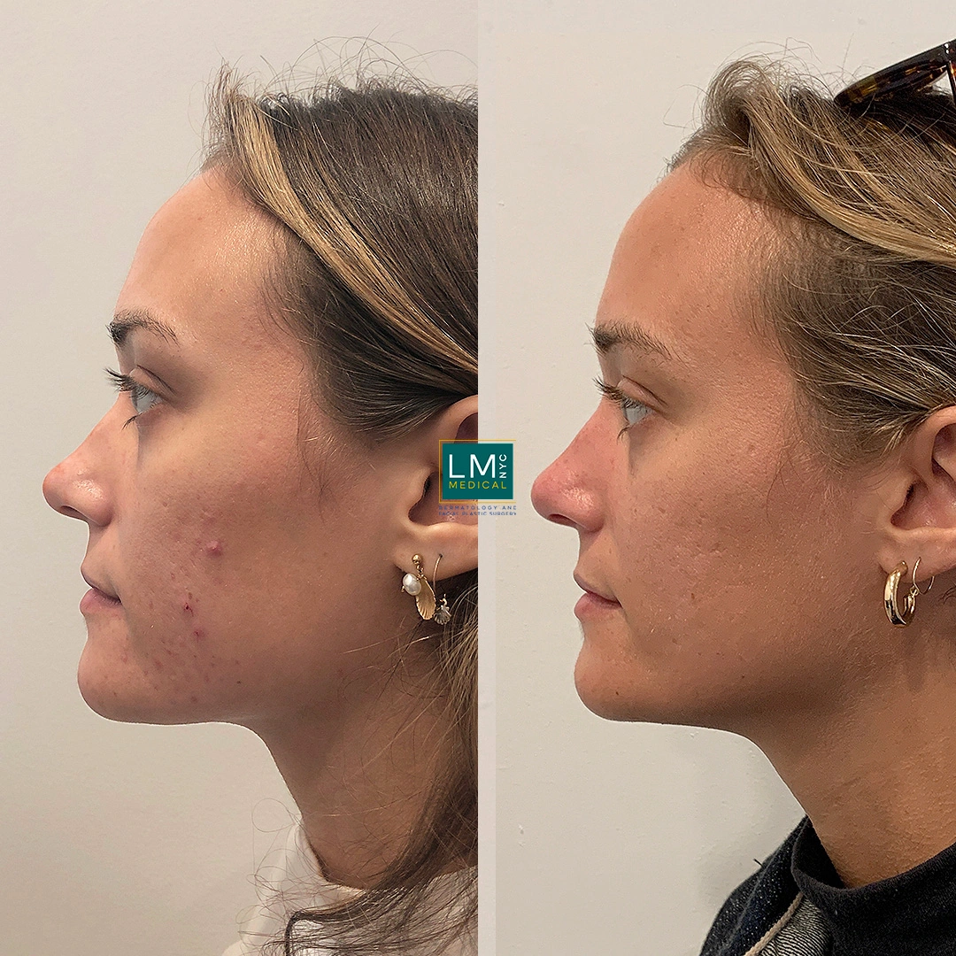 microneedling b&a left.JPG