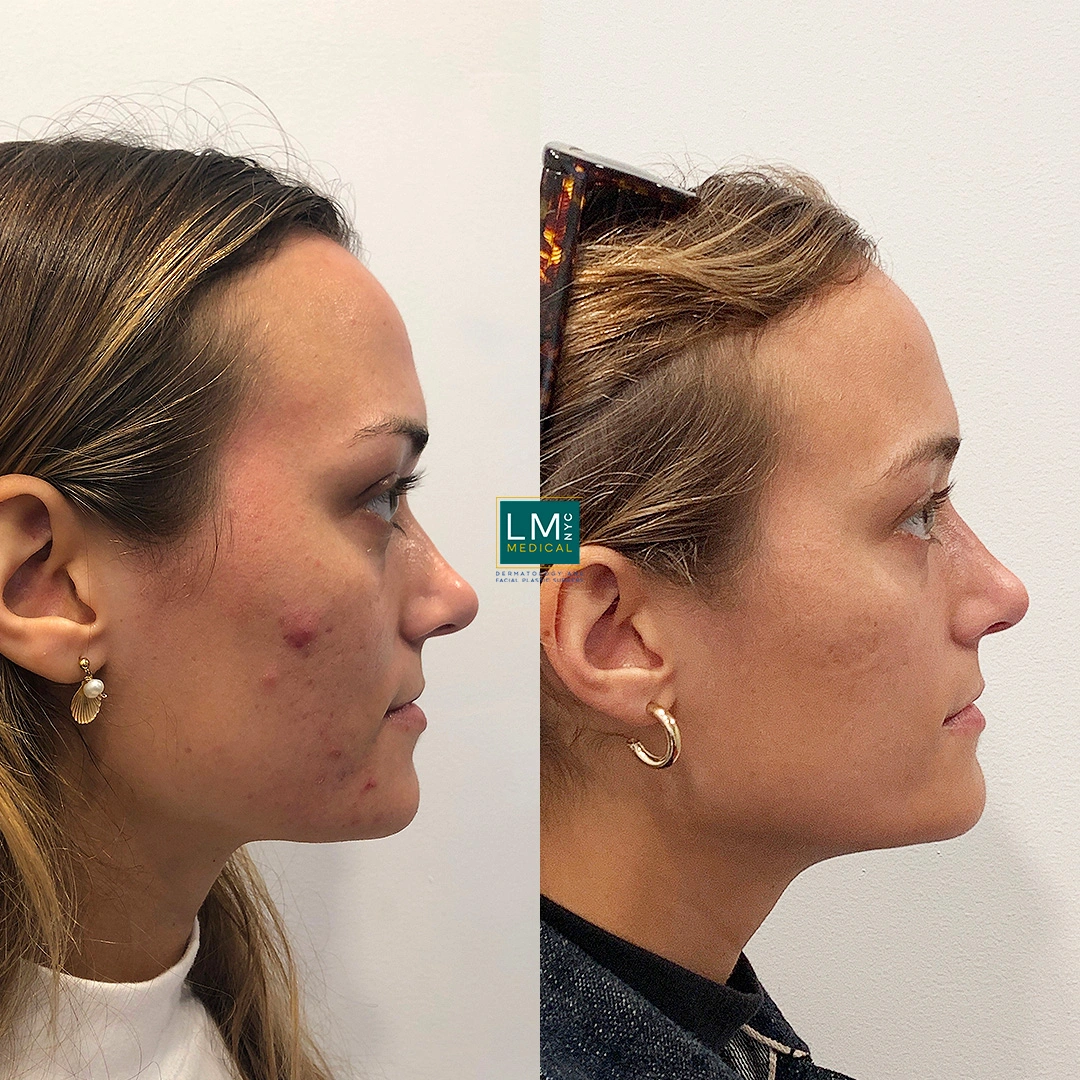 microneedling b&a right.JPG