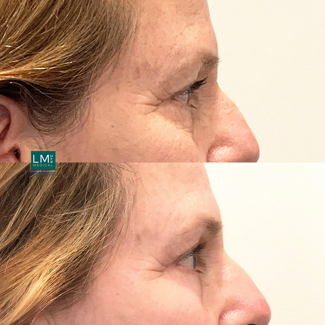 right Eyes Chemical Peel copy.JPG