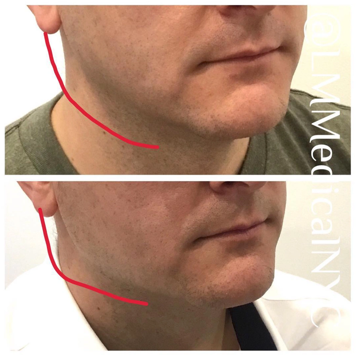 ultherapy2.PNG